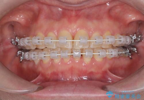 前歯の軽度なガタつきを、1年で美しく整える審美ワイヤー矯正の治療中