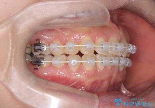 前歯の軽度なガタつきを、1年で美しく整える審美ワイヤー矯正の治療中