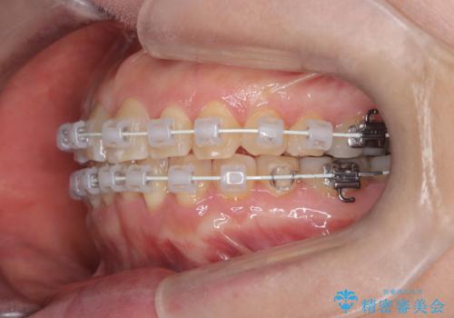 前歯の軽度なガタつきを、1年で美しく整える審美ワイヤー矯正の治療中