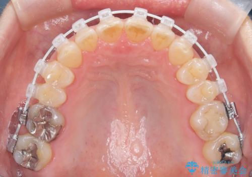 前歯の軽度なガタつきを、1年で美しく整える審美ワイヤー矯正の治療中