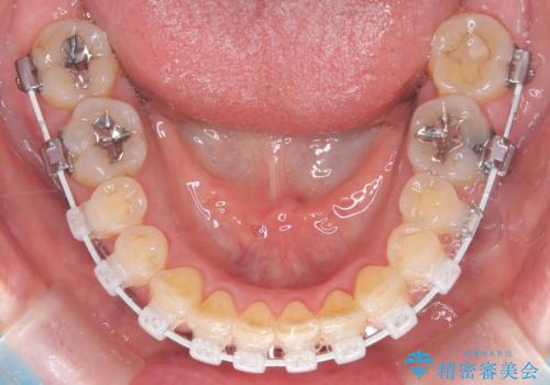 前歯の軽度なガタつきを、1年で美しく整える審美ワイヤー矯正の治療中