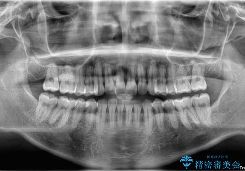 矯正後の後戻りをインビザラインライトで再治療|目立たない矯正の症例紹介の治療前