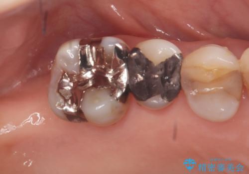 重度歯周病で失った奥歯2本を、抜歯即時インプラントで早期回復の治療前