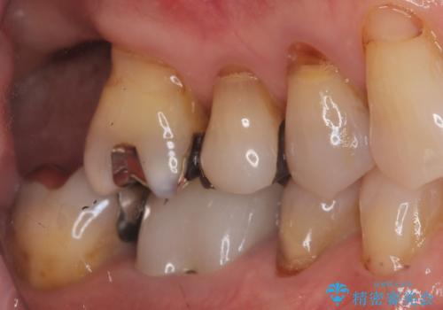 重度歯周病で失った奥歯2本を、抜歯即時インプラントで早期回復の治療前