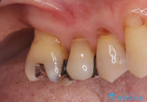 重度歯周病で失った奥歯2本を、抜歯即時インプラントで早期回復の症例 治療前