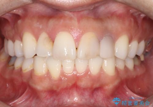 欠けて変色した前歯を一新!オールセラミックで叶える自然な笑顔の症例 治療前