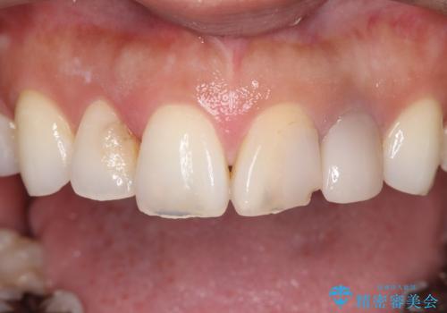 欠けて変色した前歯を一新!オールセラミックで叶える自然な笑顔の治療前