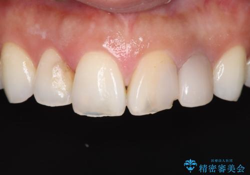 欠けて変色した前歯を一新!オールセラミックで叶える自然な笑顔の治療前