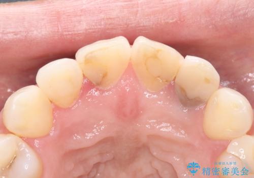 欠けて変色した前歯を一新!オールセラミックで叶える自然な笑顔の治療前
