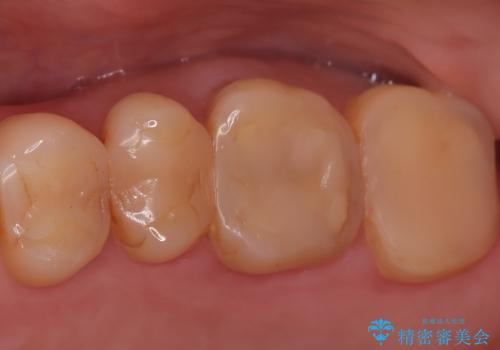 奥歯の痛みを根本から解消し、クラウンで歯の強度を回復の治療前