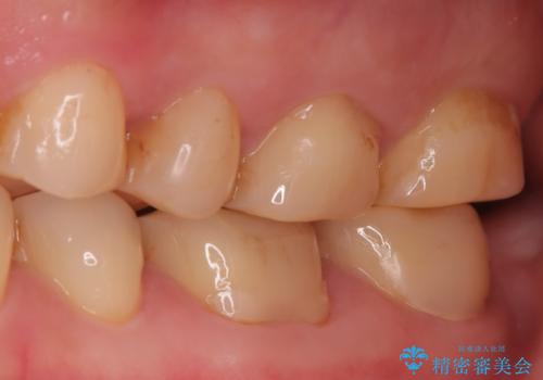 奥歯の痛みを根本から解消し、クラウンで歯の強度を回復の治療前