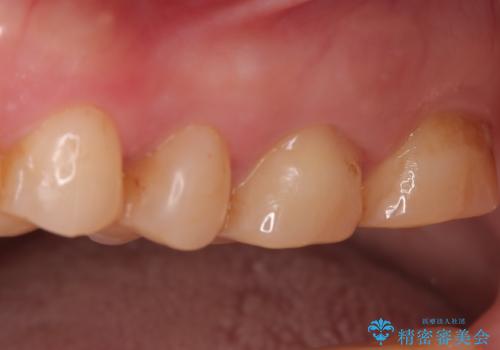 奥歯の痛みを根本から解消し、クラウンで歯の強度を回復の症例 治療前