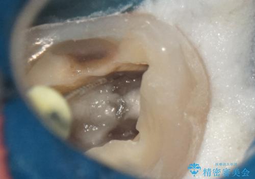 奥歯の痛みを根本から解消し、クラウンで歯の強度を回復の治療前