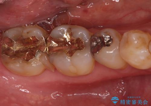 欠けた奥歯の強度を向上!PGAクラウンで安心の咬み心地を再建の治療前