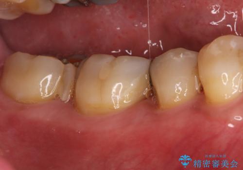 欠けた奥歯の強度を向上!PGAクラウンで安心の咬み心地を再建の症例 治療前