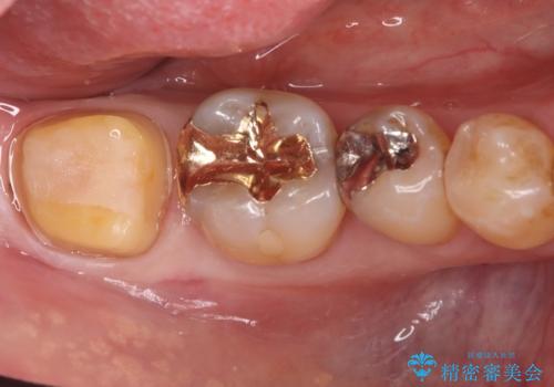 欠けた奥歯の強度を向上!PGAクラウンで安心の咬み心地を再建の治療中