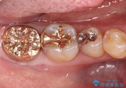 欠けた奥歯の強度を向上!PGAクラウンで安心の咬み心地を再建の治療後