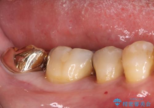 欠けた奥歯の強度を向上!PGAクラウンで安心の咬み心地を再建の症例 治療後