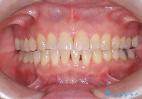 前歯の軽度なガタつきを、1年で美しく整える審美ワイヤー矯正の治療後