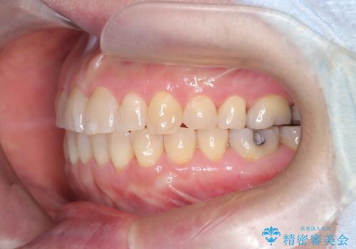 前歯の軽度なガタつきを、1年で美しく整える審美ワイヤー矯正の治療後