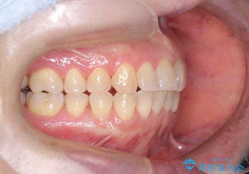 前歯の軽度なガタつきを、1年で美しく整える審美ワイヤー矯正の治療後