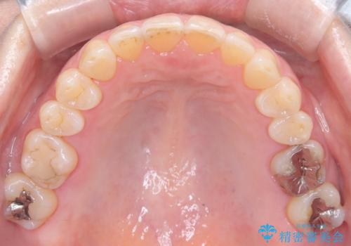 前歯の軽度なガタつきを、1年で美しく整える審美ワイヤー矯正の治療後