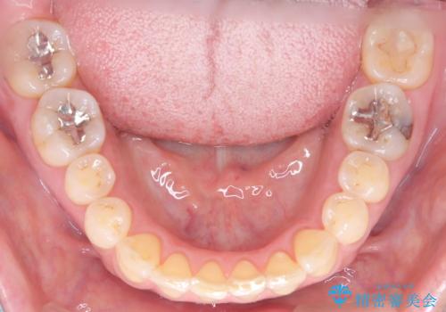 前歯の軽度なガタつきを、1年で美しく整える審美ワイヤー矯正の治療後