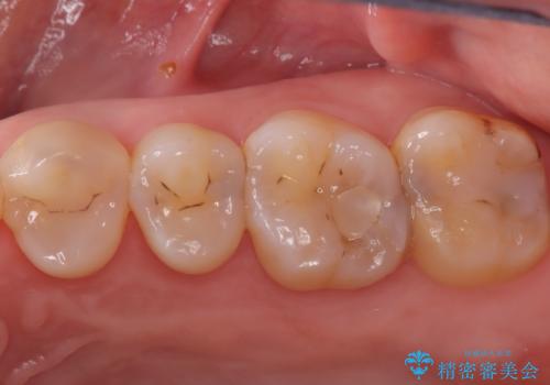 2回で完了した奥歯のセラミック修復の症例 治療前