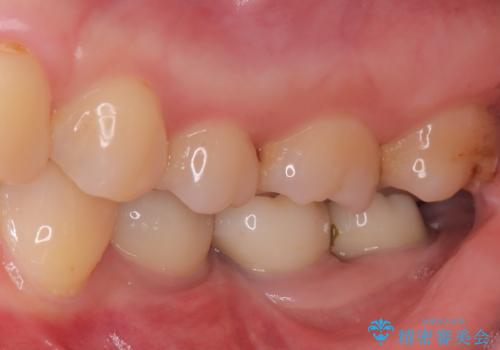 2回で完了した奥歯のセラミック修復の治療前