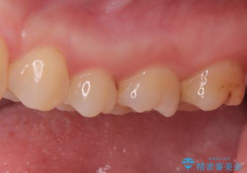 2回で完了した奥歯のセラミック修復の治療前