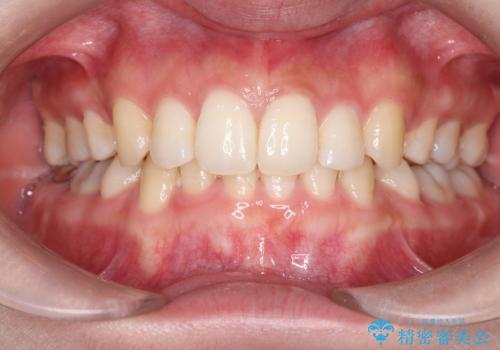 重度の歯のがたつきを、目立たない矯正と抜歯で根本改善の治療後