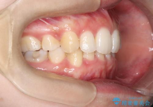 重度の歯のがたつきを、目立たない矯正と抜歯で根本改善の治療後