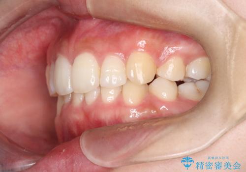 重度の歯のがたつきを、目立たない矯正と抜歯で根本改善の治療後