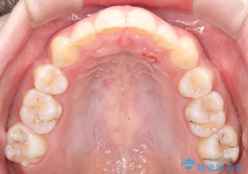 重度の歯のがたつきを、目立たない矯正と抜歯で根本改善の治療後