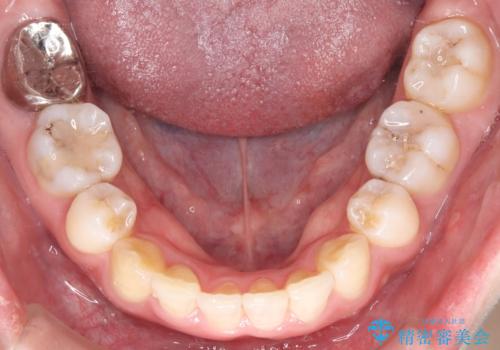重度の歯のがたつきを、目立たない矯正と抜歯で根本改善の治療後
