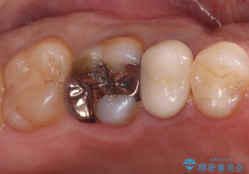 奥歯の銀歯を美しく一新!歯の破折を防ぐセラミッククラウンの治療前