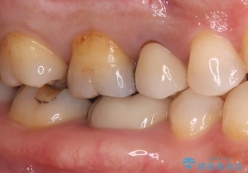 奥歯の銀歯を美しく一新!歯の破折を防ぐセラミッククラウンの治療前