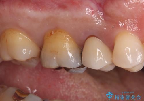 奥歯の銀歯を美しく一新!歯の破折を防ぐセラミッククラウンの治療前