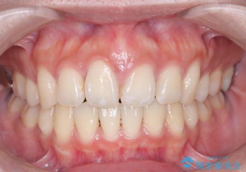 口元の突出感を解消し、横顔を美しく整えるワイヤー矯正の治療後