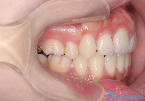 口元の突出感を解消し、横顔を美しく整えるワイヤー矯正の治療後