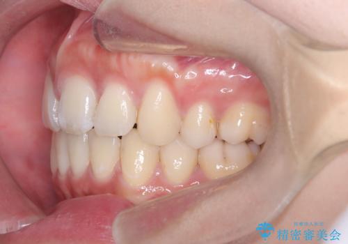 口元の突出感を解消し、横顔を美しく整えるワイヤー矯正の治療後