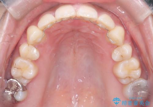 口元の突出感を解消し、横顔を美しく整えるワイヤー矯正の治療後