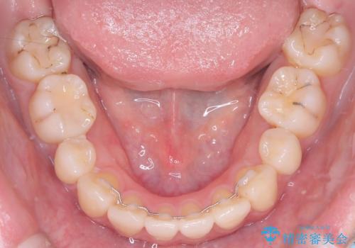 口元の突出感を解消し、横顔を美しく整えるワイヤー矯正の治療後