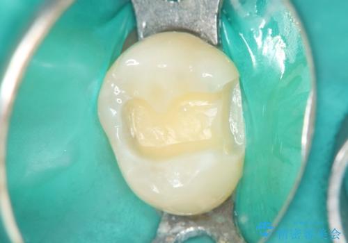 2回で完了した奥歯のセラミック修復の治療中