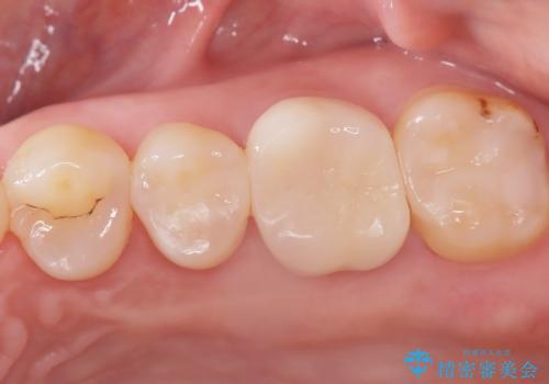 2回で完了した奥歯のセラミック修復の治療後
