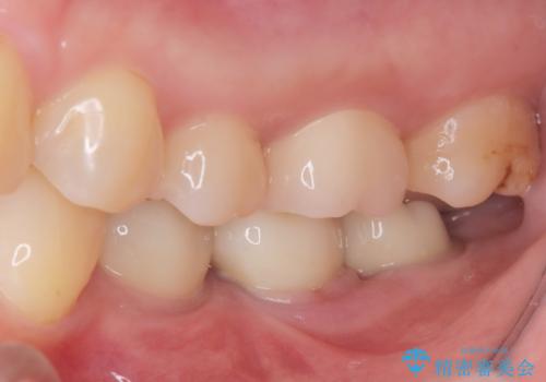2回で完了した奥歯のセラミック修復の治療後