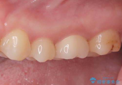 2回で完了した奥歯のセラミック修復の治療後