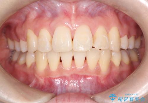 八重歯と正中のズレを解消!目立ちにくいワイヤー矯正で美しい歯並びへの治療後