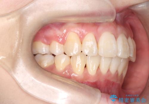 八重歯と正中のズレを解消!目立ちにくいワイヤー矯正で美しい歯並びへの治療後