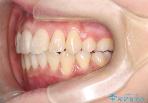 八重歯と正中のズレを解消!目立ちにくいワイヤー矯正で美しい歯並びへの治療後